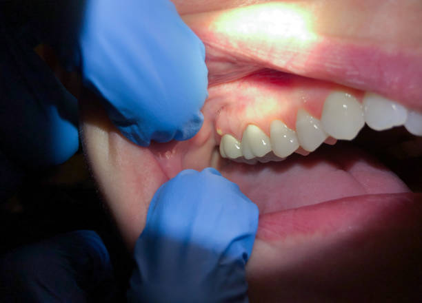 Best Broken Tooth Emergency  in Lake Marcel Stillter, WA