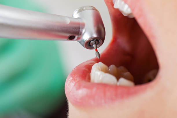 Best Chipped Tooth Repair Near Me  in Lake Marcel Stillter, WA